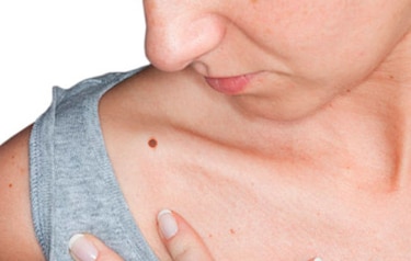 Lanzan campaña contra el cáncer de piel