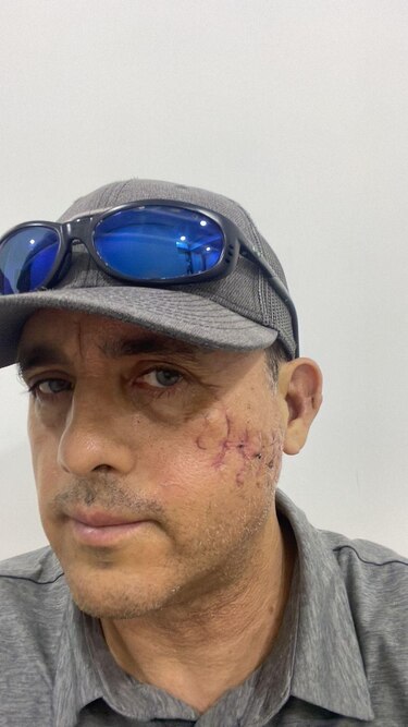 ‘Me perdonó la vida’: el relato del mexicano que sobrevivió a la mordida de un tiburón en la cabeza