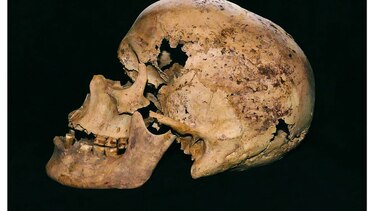 Caso más antiguo de cáncer de pecho