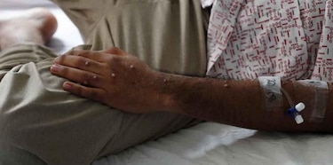 Nueva variante de la viruela del mono no ha llegado a Panamá; el país acumula 241 casos de otra cepa