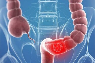 Cáncer colorrectal aumenta significativamente en los jóvenes en Estados Unidos