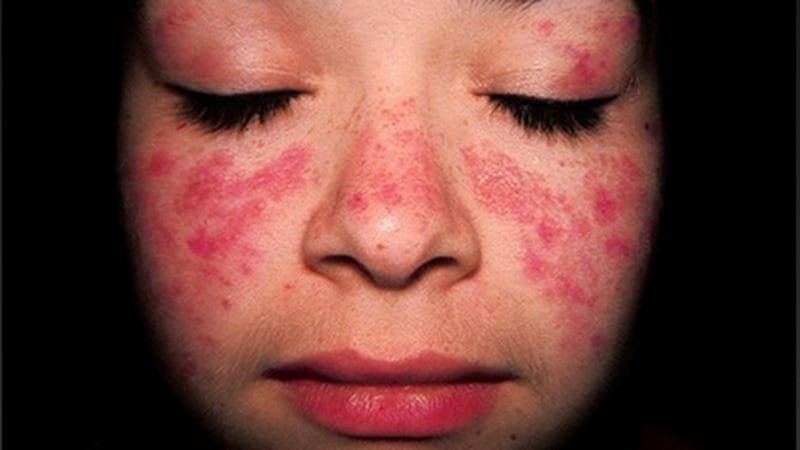 Lupus en Panamá, entre la falta de datos y el acceso desigual a tratamientos