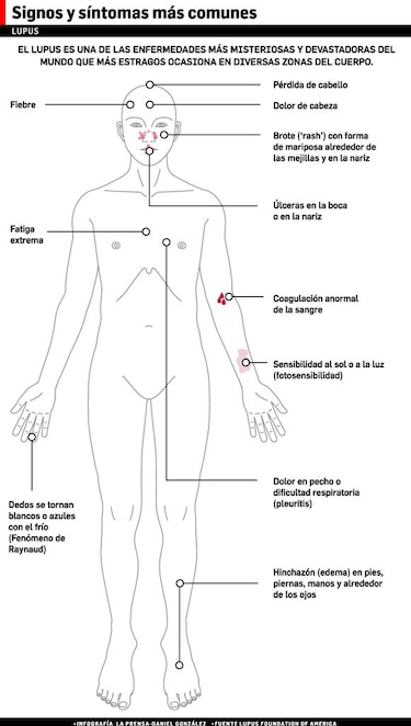 Lupus en Panamá, entre la falta de datos y el acceso desigual a tratamientos