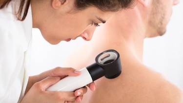 El melanoma será el segundo tumor en incidencia global para 2040, según los dermatólogos