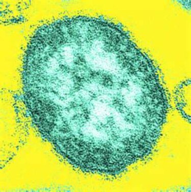 Mujer se cura de cáncer con dosis masiva de virus de sarampión