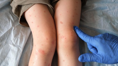 La región de las Américas ya no está libre de sarampión, confirma la OPS