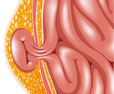 ¿Es  ese bulto  una hernia?