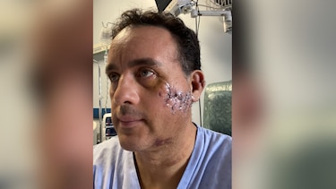 ‘Me perdonó la vida’: el relato del mexicano que sobrevivió a la mordida de un tiburón en la cabeza