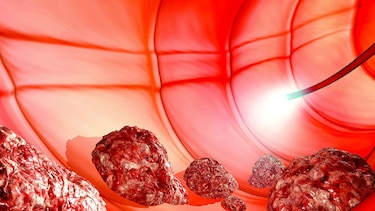 Cuidado con el cáncer colorrectal