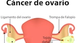 El silencioso cáncer de ovario