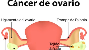 El silencioso cáncer de ovario