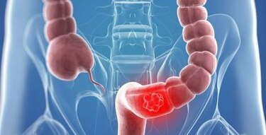 Sube la mortalidad por cáncer de colon en menores de 55 años en Estados Unidos
