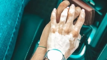 Vitiligo, una enfermedad que no debe causar vergüenza