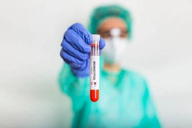 Minsa informa que se confirman dos nuevos casos de la viruela símica