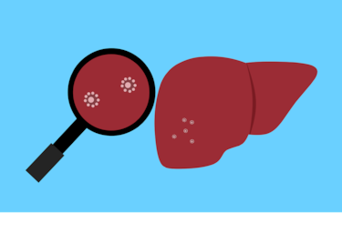 Hepatocarcinoma: prevalencia, diagnóstico y nuevas terapias