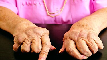 20 mil personas padecen de artritis en Panamá