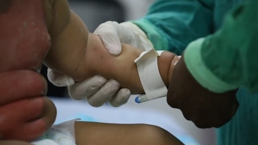 Más de 500 niños quemados han sido hospitalizados este año en el Hospital del Niño