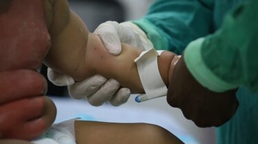 Más de 500 niños quemados han sido hospitalizados este año en el Hospital del Niño