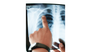 Tuberculosis, una enfermedad infecciosa que aún no se ha erradicado en Panamá