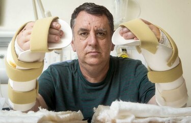 Él es Chris King, el primer hombre en el mundo al que le trasplantaron dos manos exitosamente
