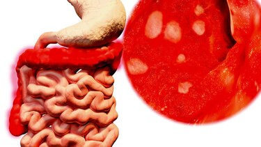 Inflamación intestinal