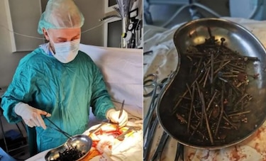 Médicos lituanos hallan un kilo de clavos y tornillos en estómago de paciente