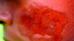 Crema tópica, efectiva contra la leishmaniasis