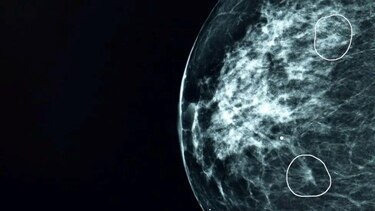La IA encontró mi cáncer de mama porque era demasiado pequeño para ser detectado por el ojo humano