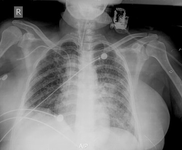 Tuberculosis en Panamá: Estas son las regiones donde se concentra la enfermedad