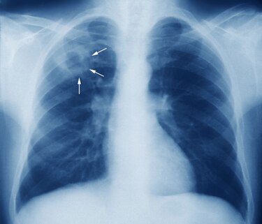 Tuberculosis: por un diagnóstico temprano