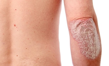 Fundación Psoriasis de Panamá presenta campaña