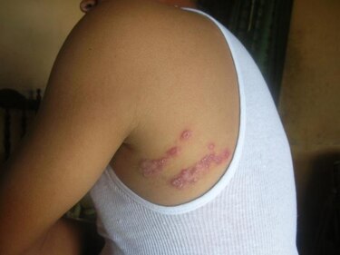Hallan en molusco marino compuesto activo contra la leishmaniasis