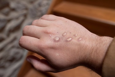 Dermatólogos españoles demuestran que la transmisión principal de la viruela del mono es por contacto de la piel