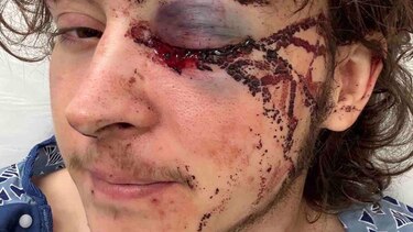 ‘Los médicos dicen que estoy vivo de milagro’: el joven que perdió un ojo durante una protesta contra ICE en California