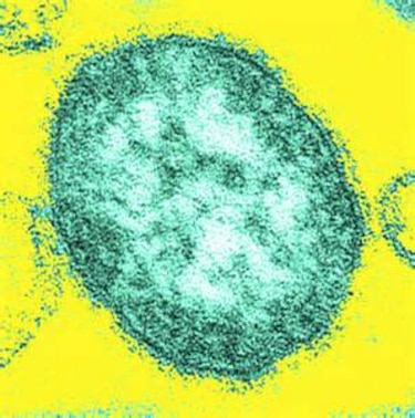 Mujer se cura de cáncer con dosis masiva de virus de sarampión