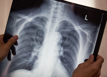 Panamá lucha contra la tuberculosis: 401 casos y 15 fallecidos en el primer trimestre
