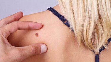 Realizarán jornada de prevención contra el cáncer de piel