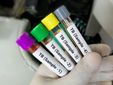 Urge que la tuberculosis se encare con más beligerancia