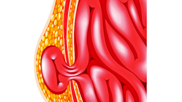 ¿Es ese bulto una hernia?