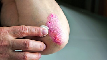 De la piel a las articulaciones, el riesgo oculto de la psoriasis