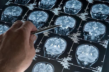 Estados Unidos aprueba nuevo medicamento contra el alzheimer, el primero en casi dos décadas