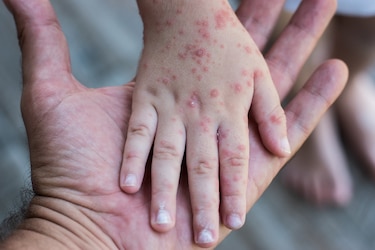 Un solo infectado por sarampión podría contagiar a 18 personas, afirma epidemiólogo