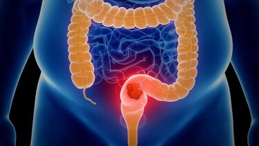 Riesgos, señales y prevención: entendiendo el cáncer colorrectal