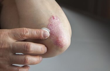 El reto de vivir con psoriasis