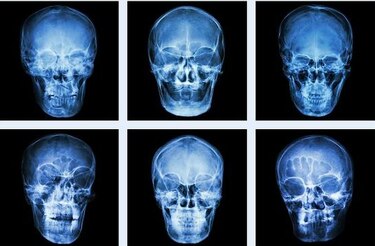 Cirugías menos invasivas al tratar tumores en el cerebro