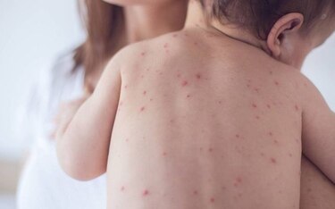 El sarampión es mucho más que un rash con fiebre