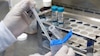 Tuberculosis: detectarla a tiempo salva vidas