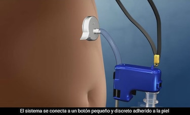 Crean dispositivo que permite conectar puerto externo a la barriga para bajar de peso