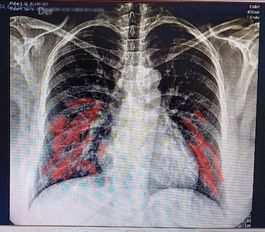 El 89% que me llevó a ser ingresada en el Hospital Modular