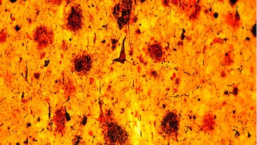 Resultados prometedores contra el Alzheimer